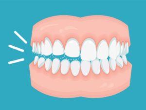 Quem tem bruxismo pode fazer implante dentário?